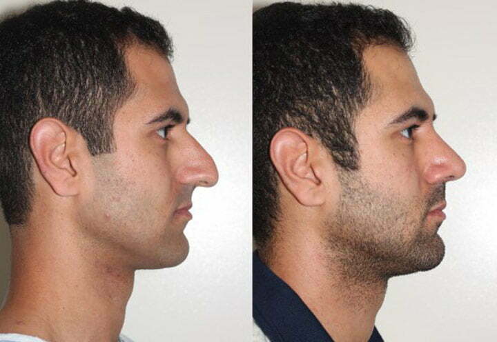 Nose Surgery in Iran