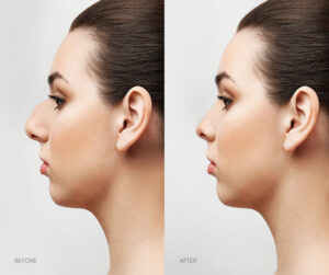 Rhinoplasty in Iran Rhinoplasty in Iran
