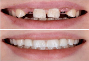 Dental Implant in iran