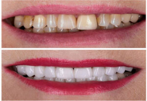 Dental Veneers in iran