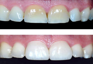 Teeth whitening in Iran