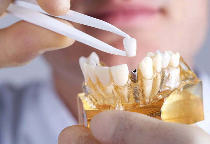 dental Implants in Iran