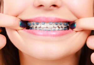 orthodontics in iran