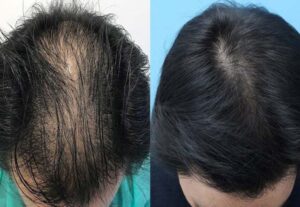 Hair Restoration in Iran