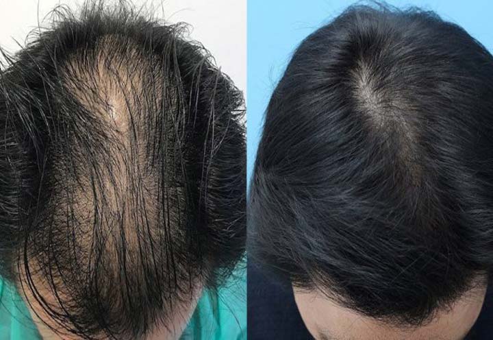 Hair Restoration in Iran