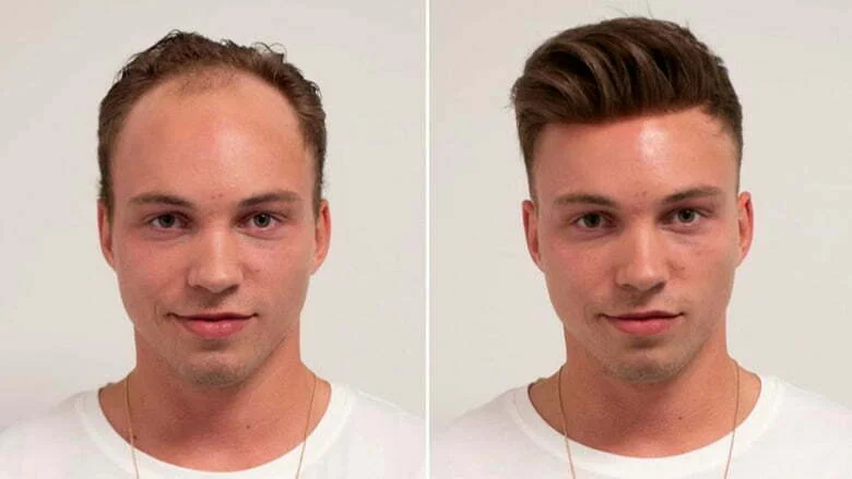 Hair Transplant in Iran Hair Transplant in Iran