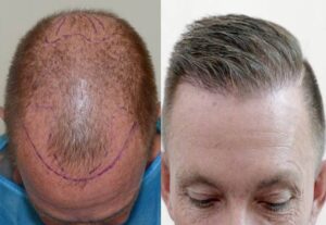 Hair transplant by Iranian surgeons