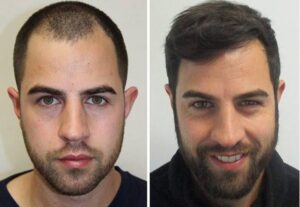 Hair transplant cost in Iran
