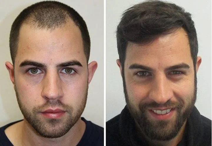 Hair transplant cost in Iran