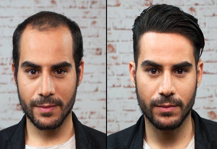 Hair transplant in Iran-health tour.jpg