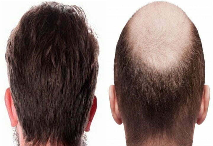 Hair transplant in Iran-medical tour