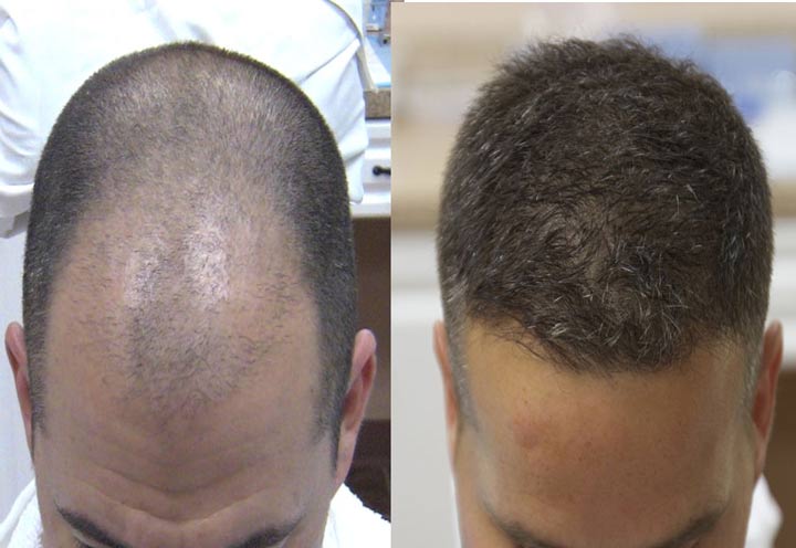 Iran hair transplant