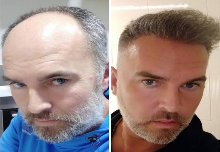 Iran hair transplant cost