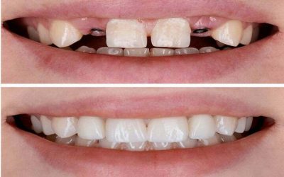 Dental Implant in iran