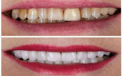 Dental Veneers in iran