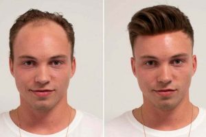 Hair Transplant in Iran