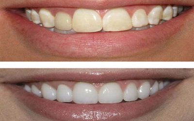 Teeth polishing in Iran