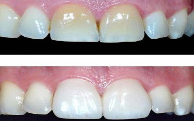 Teeth whitening in Iran