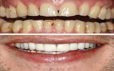 cosmetic dentistry in Iran-medical tour