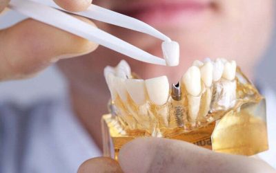 dental Implants in Iran