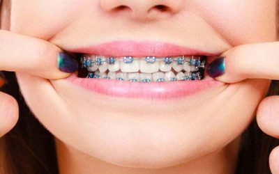 orthodontics in iran