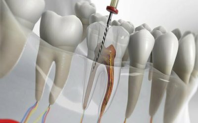 root canal in Iran